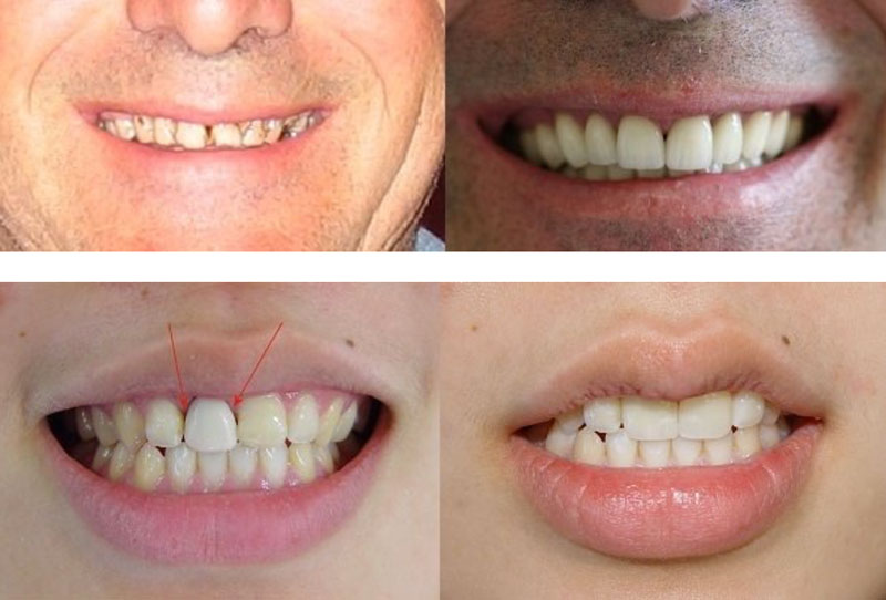 tooth veneer