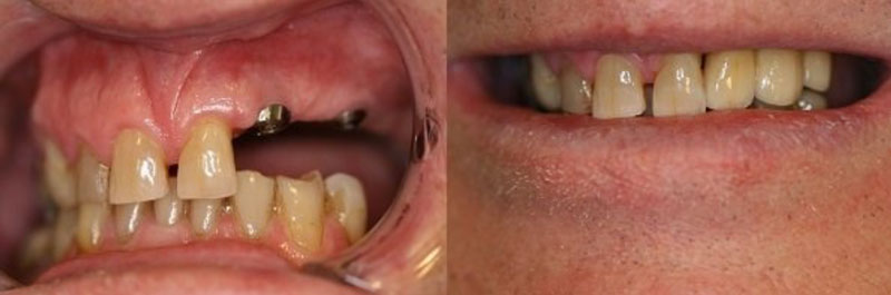 dental implants cost nz dental implants cost nz