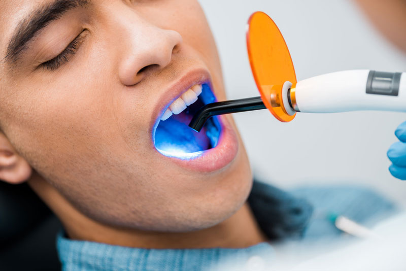 tooth filling cost auckland