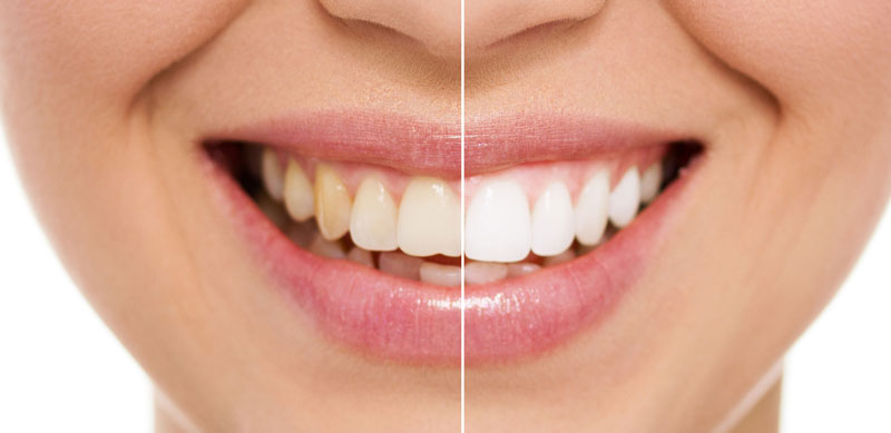 tooth whitening nz