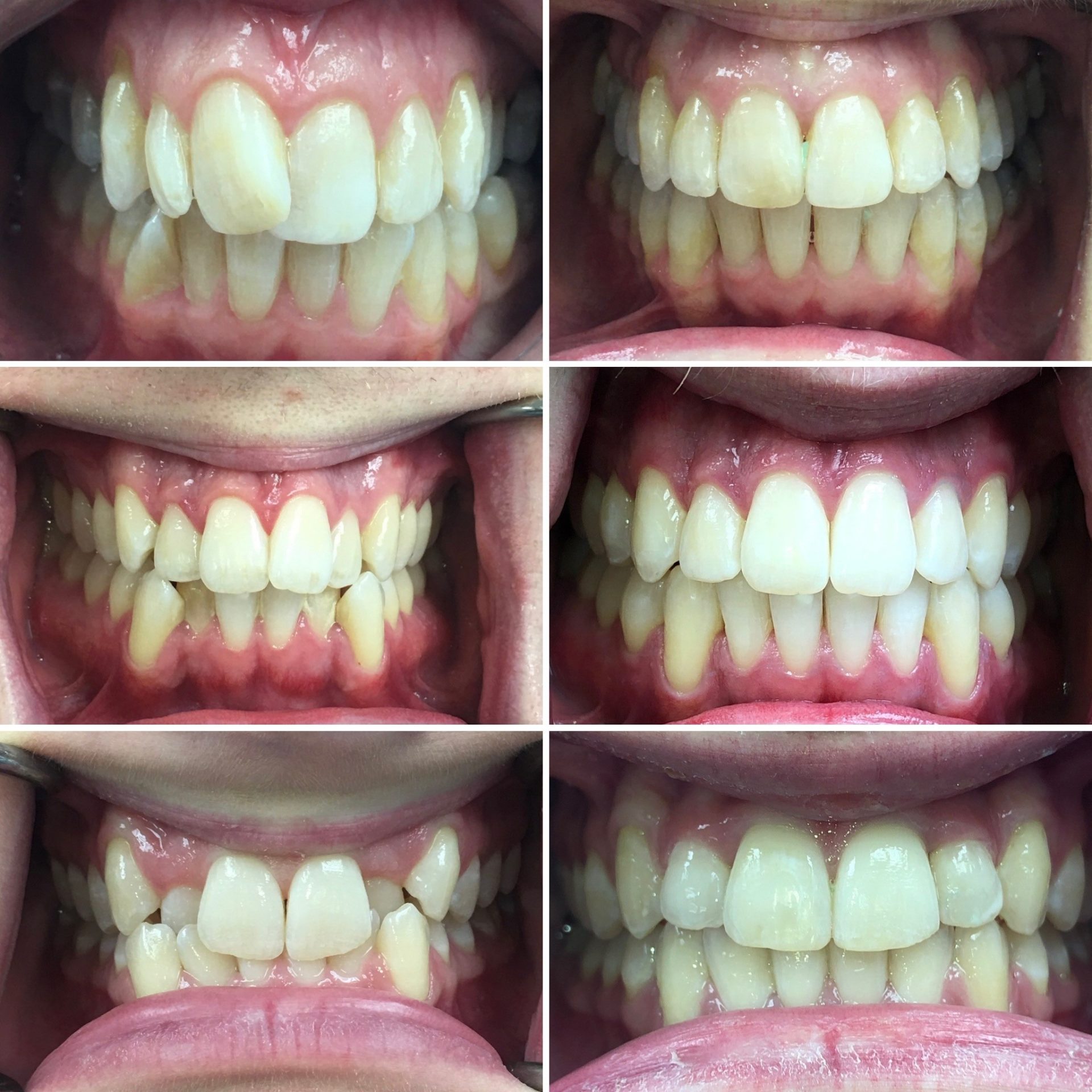 With Invisalign Braces You’ll Be All Smiles No Pain Or Shame